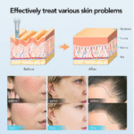 M8S Dr Pen Derma Pen MTS Microneedling Machine