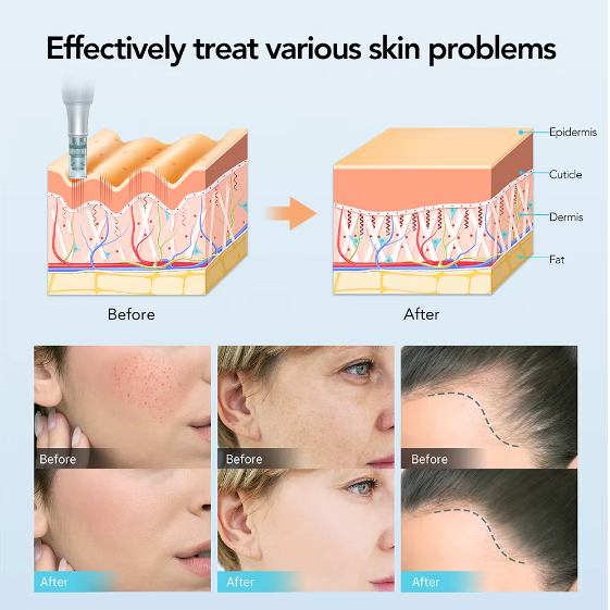 M8S Dr Pen Derma Pen MTS Microneedling Machine